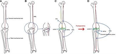 Early results of high tibial osteotomy versus combined arthroscopic surgery